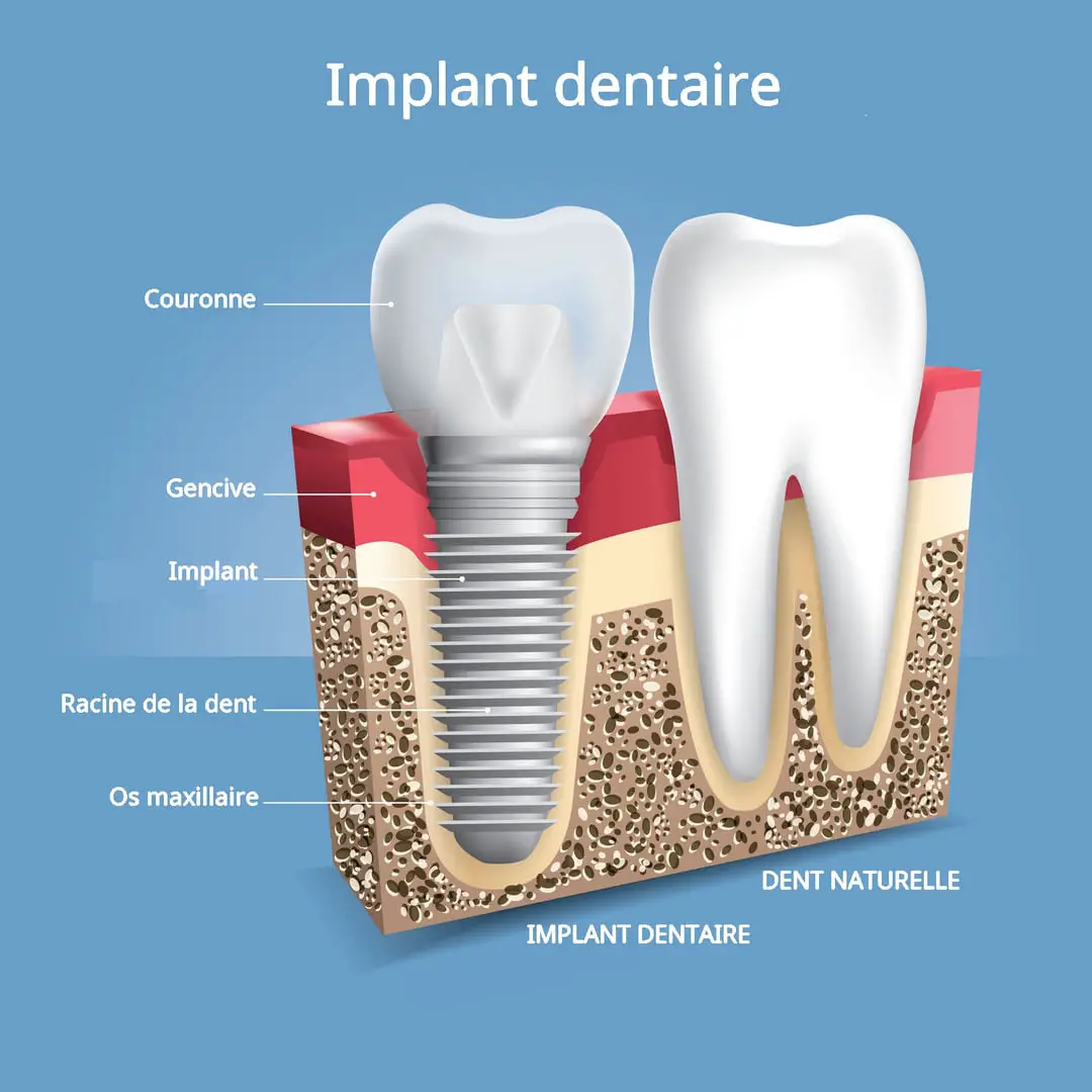 Implant dentaire Lyon : quelles sont les technologies utilisées ?